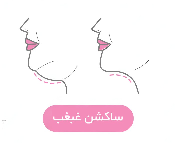 تاثیر ساکشن غبغب