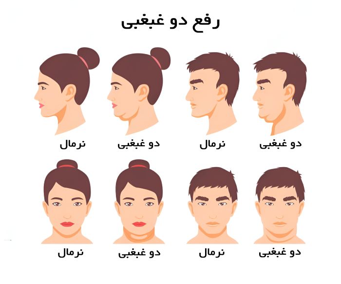 رفع دو غبغبی