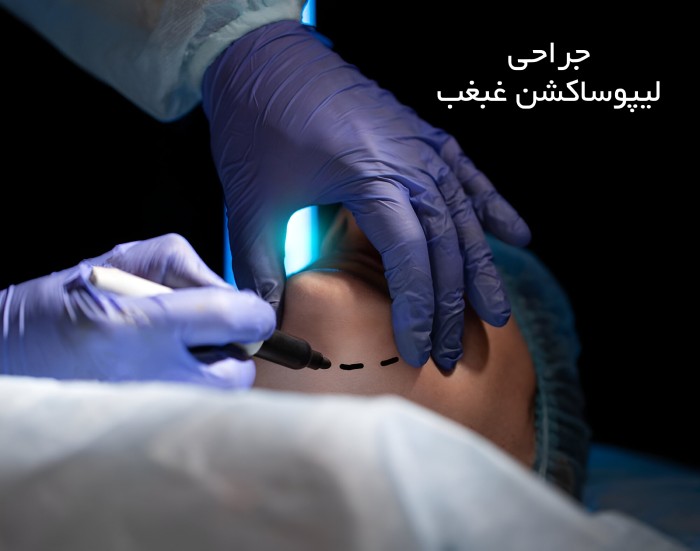 هزینه جراحی ساکشن غبغب