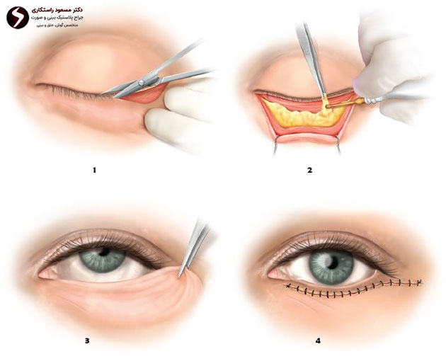 مراحل انتخاب بهترین جراح بلفاروپلاستی در تهران بلفاروپلاستی-پلک-پایین