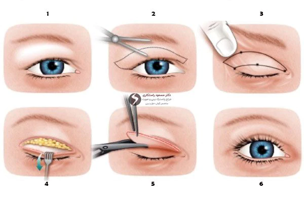 بهترین جراح پلک