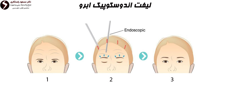 لیفت اندوسکوپیک ابرو