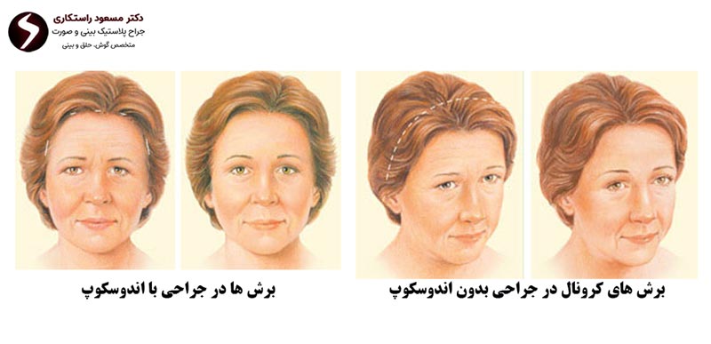 برش های جراحی لیفت پیشانی برش های جراحی لیفت پیشانی