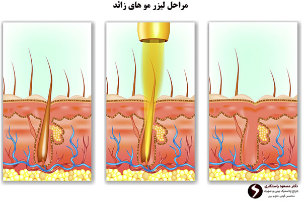 مراحل-لیزر-مو-های-زائد
