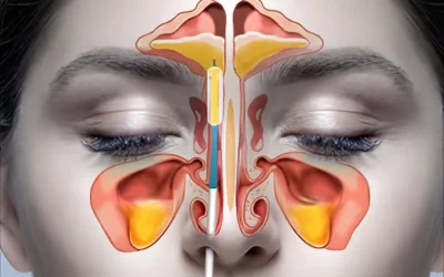آندوسکوپی سینوس و همه چیز درباره آن