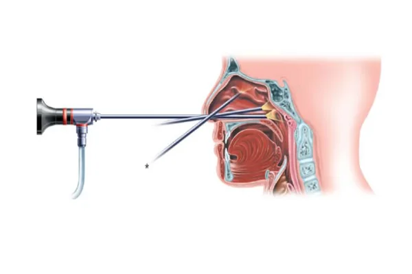 آندوسکوپی سینوس چیست