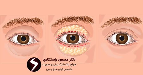 جراحی پلک جراحی پلک