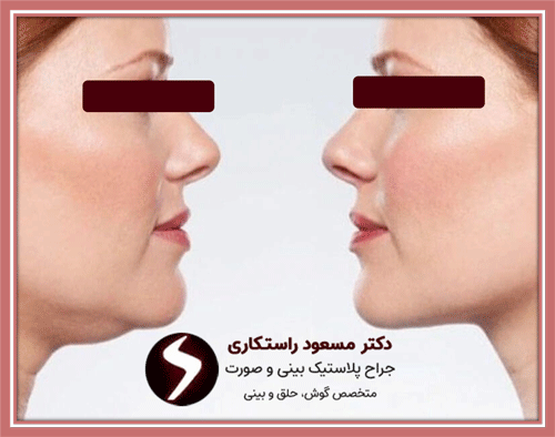 لیپوماتیک غبغب