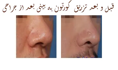 قبل و بعد از تزریق کورتون بعد از جراحی بینی قبل و بعد از تزریق کورتون بعد از جراحی بینی