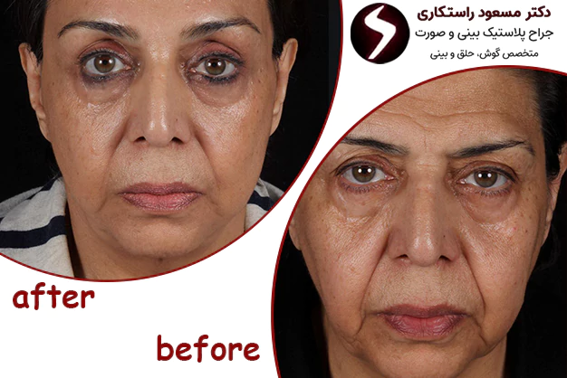 نمونه کار جراحی لیفت صورت دکتر راستکاری نمونه کار جراحی لیفت صورت دکتر راستکاری