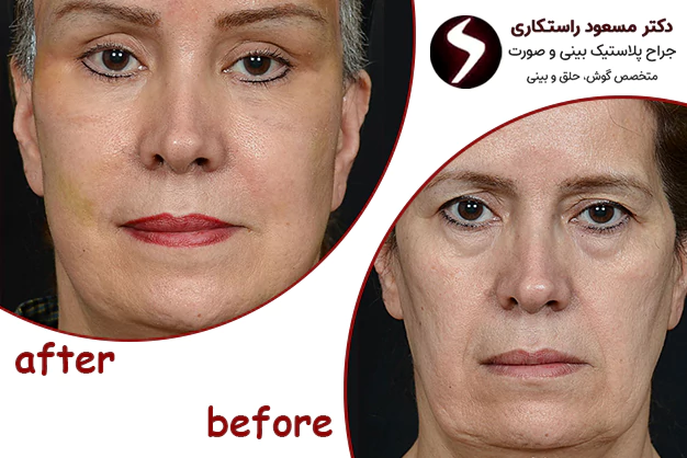 نمونه کار قبل و بعد جراحی لیفت صورت نمونه کار قبل و بعد جراحی لیفت صورت