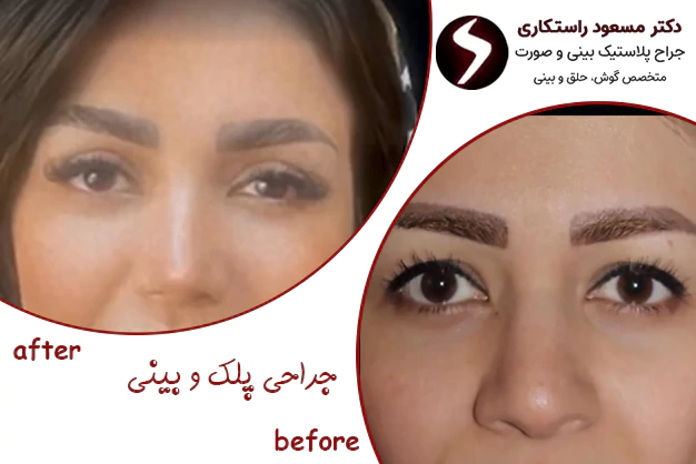 جراحی زیبایی پلک جراحی زیبایی پلک