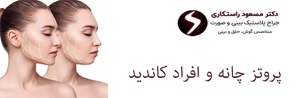 کاندید پروتز چانه