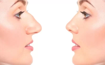 معرفی بهترین جراح بینی استخوانی + نمونه کارهای جذاب نتیجه عمل