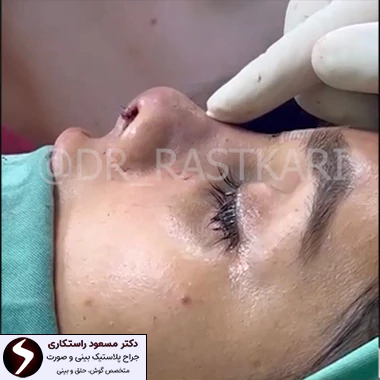 نمونه کار دکتر راستکاری بهترین جراح بینی ترمیمی نمونه کار دکتر راستکاری بهترین جراح بینی ترمیمی