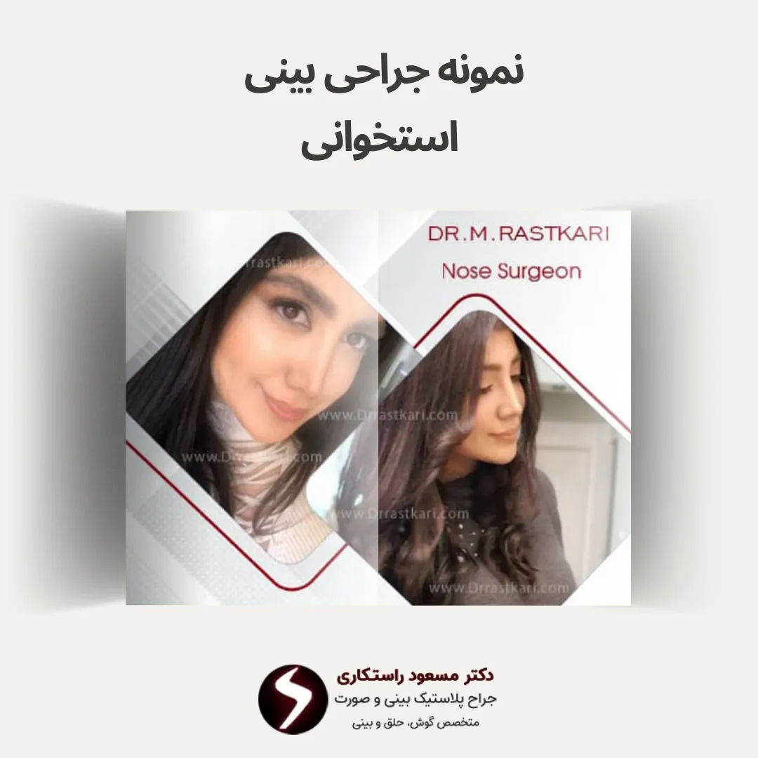 نمونه جراحی بینی استخوانی