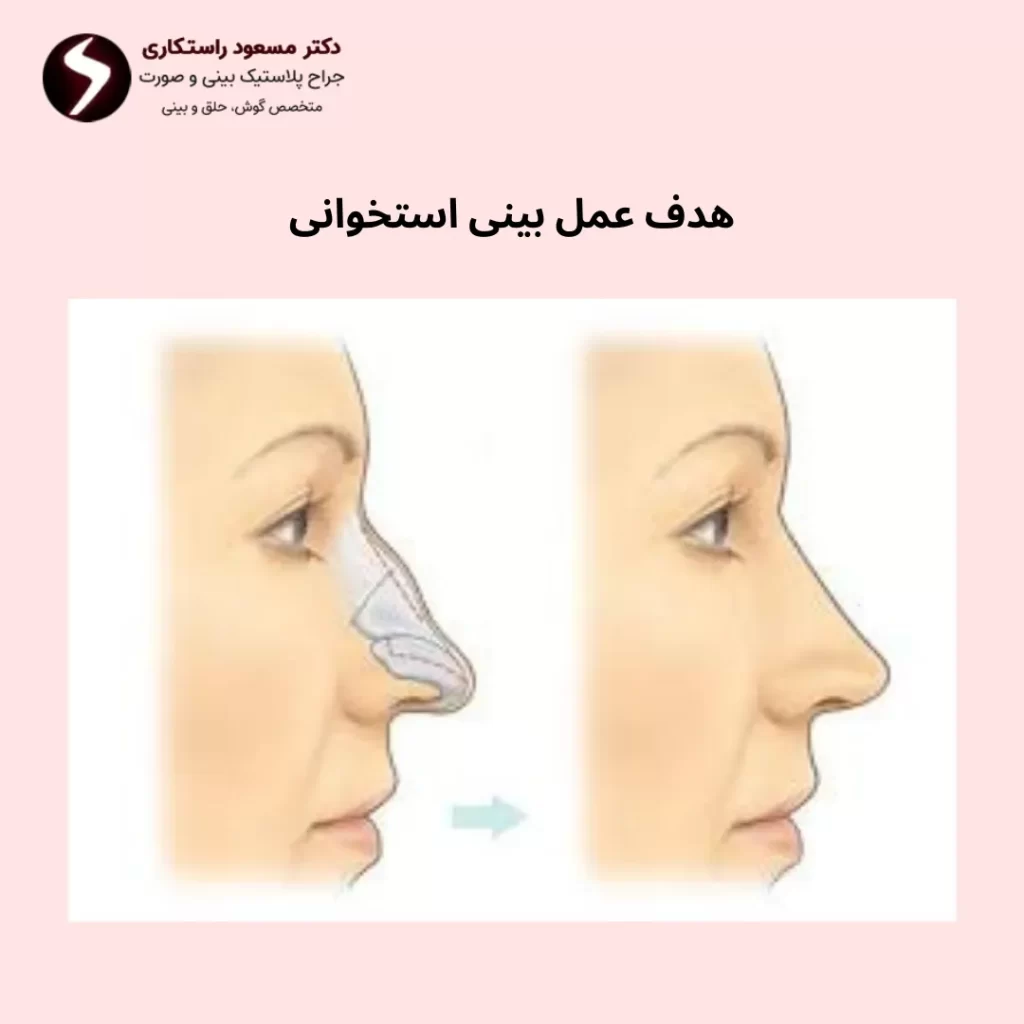 هدف جراحی بینی استخوانی