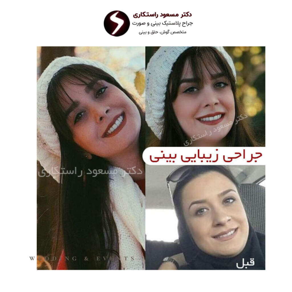 نمونه کار جراح بینی طبیعی