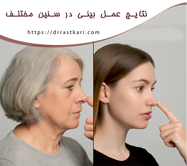 نتایج عمل بینی در سنین مختلف