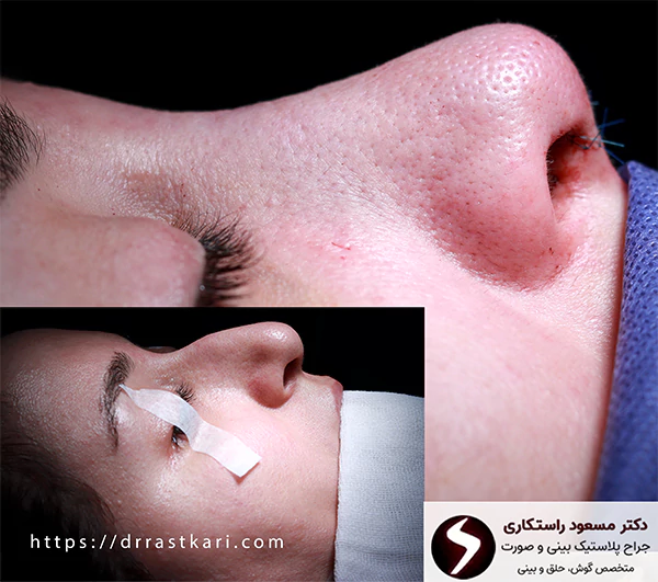 جراحی شکستگی بینی