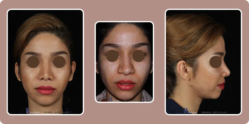 کاندیدای مناسب عمل بینی بدون تامپون