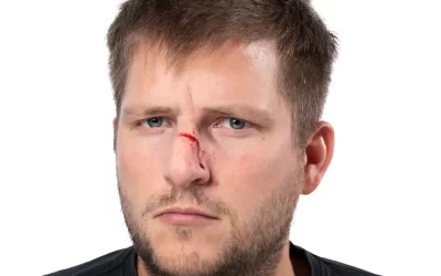 راهنمای جامع عمل شکستگی بینی + بهترین زمان جراحی بینی شکسته