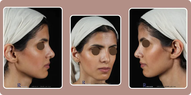 عمل شکستگی بینی عمل شکستگی بینی