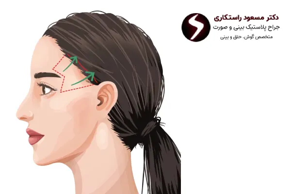 مراقبت های بعد از جراحی لیفت شقیقه چیست