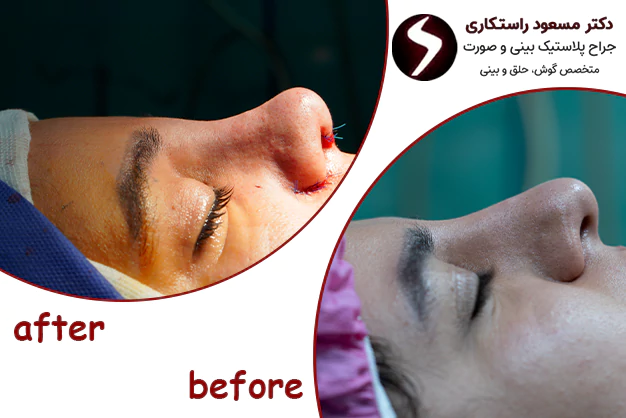 جراحی بینی فانتزی