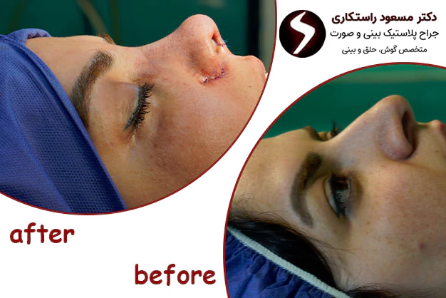 عکس نمونه کار جراحی بینی دکتر مسعود راستکاری عکس نمونه کار جراحی بینی دکتر مسعود راستکاری