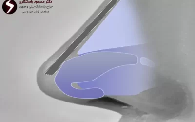 نحوه “خوابیدن بعد از عمل بینی” چگونه است؟