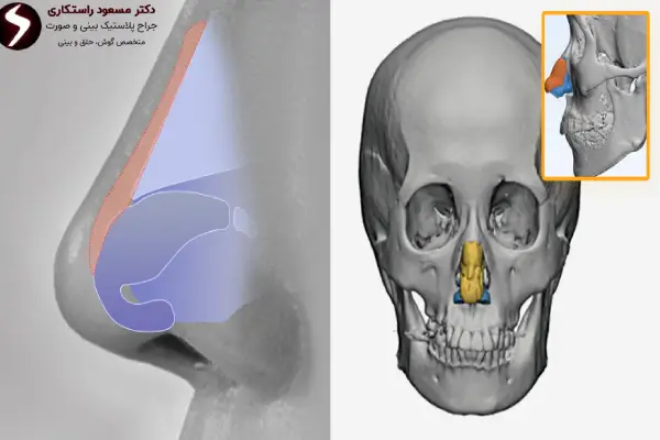 نحوه انجام عمل بینی سه بعدی