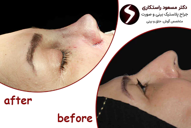 کاندیدای مناسب جراحی بینی فانتزی