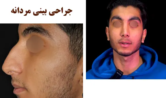جراحی بینی مردانه