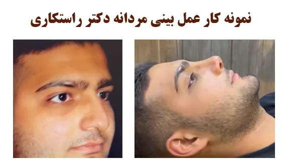 نمونه کار عمل بینی مردانه دکتر راستکاری