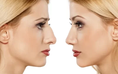 7 تفاوت اساسی بینی گوشتی و استخوانی در جراحی که باید بدانید