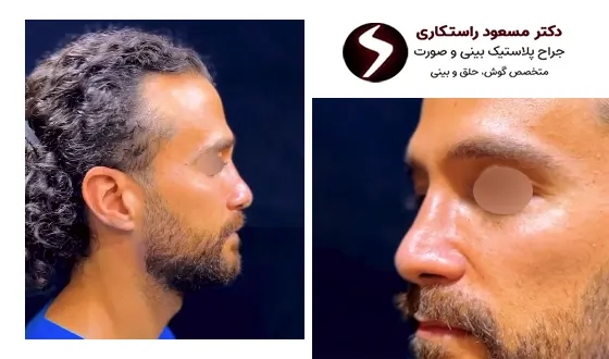 جراحی بینی آقایان جراحی بینی آقایان