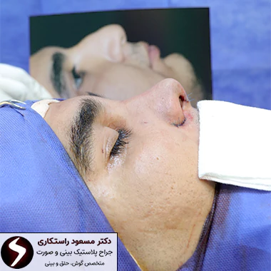 جراحی بینی طبیعی جراحی بینی طبیعی