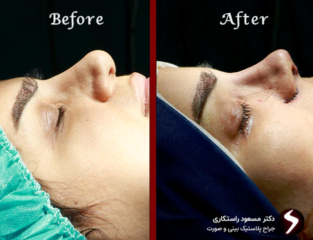 جراحی بینی نیمه فانتزی جراحی بینی نیمه فانتزی