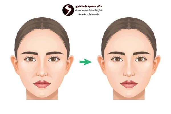 علل فرورفتگی پره های بینی بعد از عمل