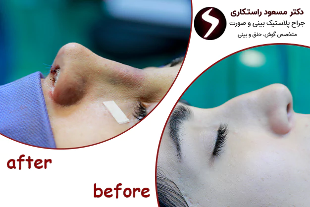 مزایای عمل بینی استخوانی عمل بینی استخوانی