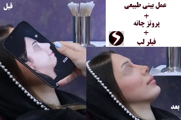 عمل بینی طبیعی در تهران