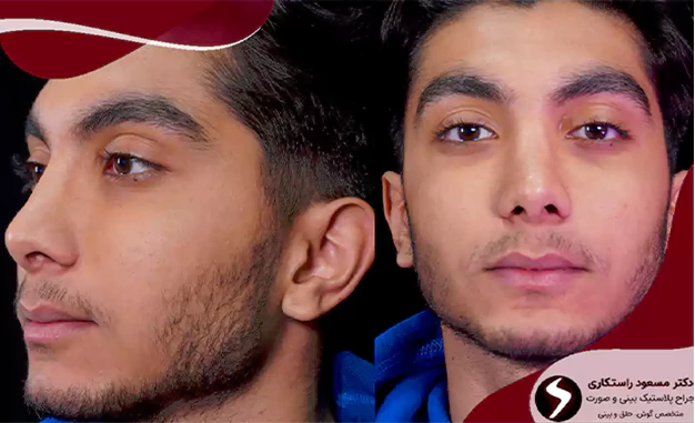 عمل بینی نیمه فانتزی برای انواع بینی‌ها