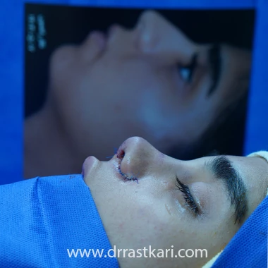 لزوم مراجعه به بهترین جراح بینی فانتزی در تهران