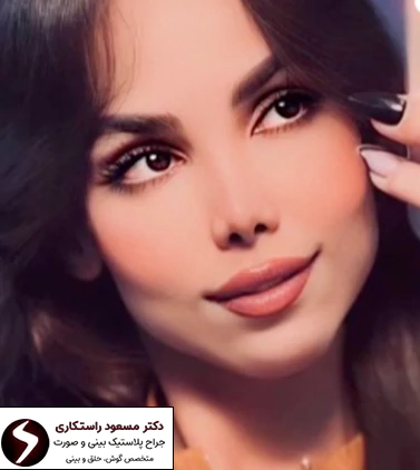 نتیجه جراحی بینی استخوانی نتیجه جراحی بینی استخوانی