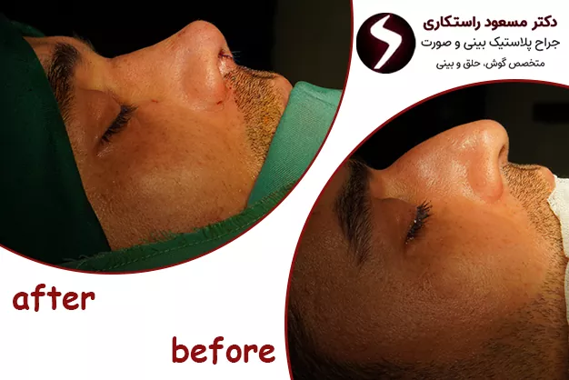 نمونه کار بهترین جراح بینی فانتزی