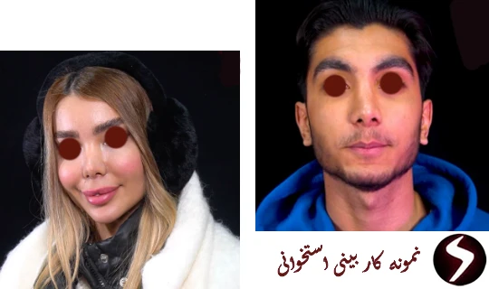 هزینه جراحی بینی استخوانی نمونه کار بینی استخوانی