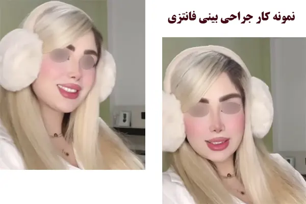 نمونه کار جراحی بینی فانتزی نمونه کار جراحی بینی فانتزی