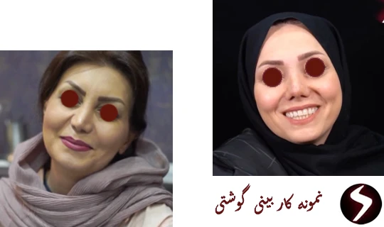 هزینه جراحی بینی گوشتی هزینه جراحی بینی گوشتی