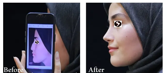 عکس قبل و بعد جراحی بینی دکتر راستکاری